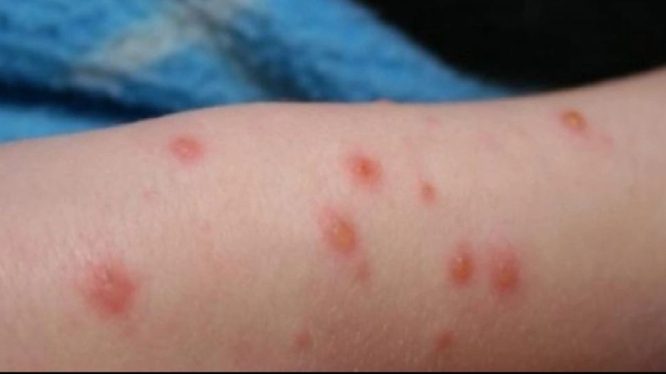 România, 85% din cazurile de rujeolă din Europa. Ministrul Sănătății: „Dezinformarea este la cote alarmante”