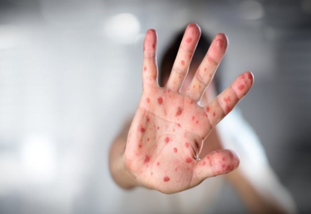 EPIDEMIE de RUJEOLĂ în România. Cum te poți proteja de această afecțiune contagioasă