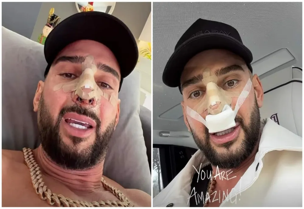 Dorian Popa și-a făcut operație de rinoplastie. Cum se simte vloggerul