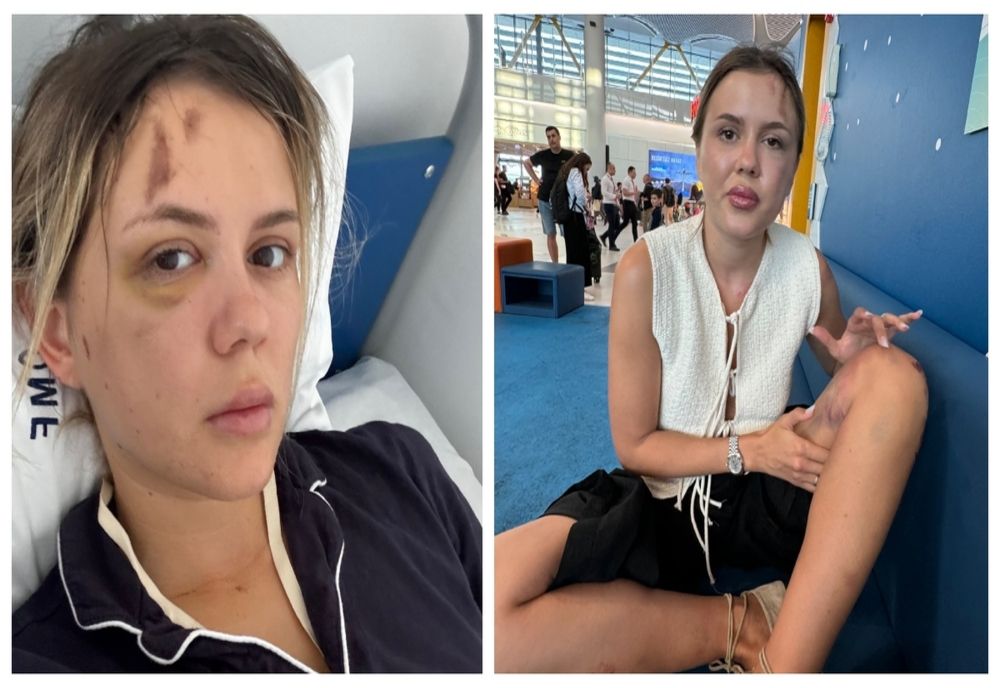 CU CE PROBLEME SE CONFRUNTĂ EMILY BURGHELEA LA CÂTEVA SĂPTĂMÂNI DE LA CUMPLITUL ACCIDENT