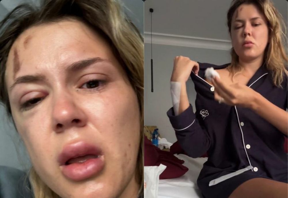 Emily Burghelea, pe masa de operații, după accidentul de mașină