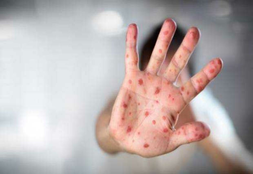 Rujeola revine la nivel global, avertizează OMS