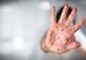 România riscă o epidemie de rujeolă! Efectele devastatoare ale bolii